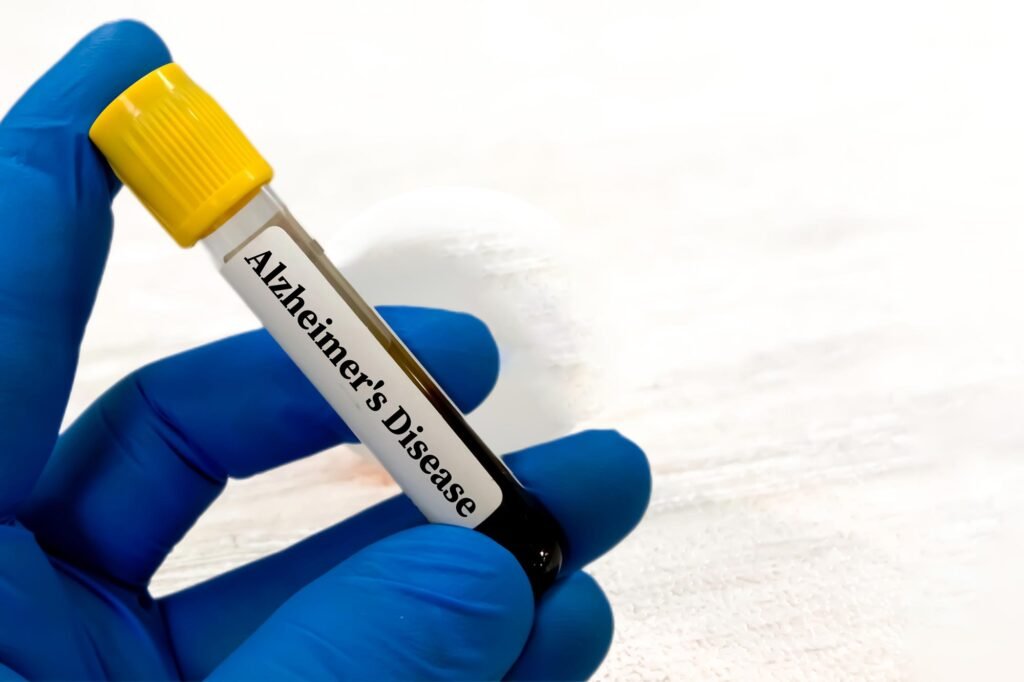 Blood Test May Show Alzheimer's Risk
