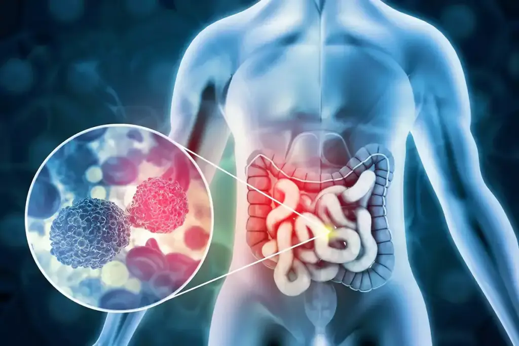 Colon Cancer Kept Away for 3 Years