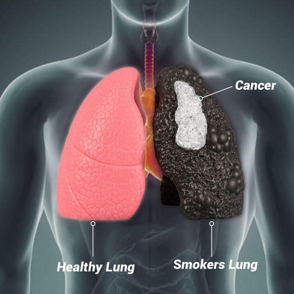 Vaping Linked to Lung Cancer Review